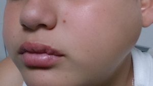 La inflamación de las glándulas salivales es el principal síntoma de las paperas.