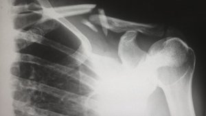 La osteoporosis es una enfermedad que afecta el sistema óseo.